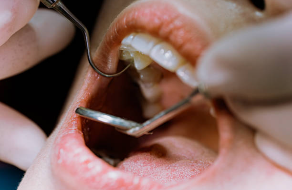 Adult dentistry in Rosarito Beach